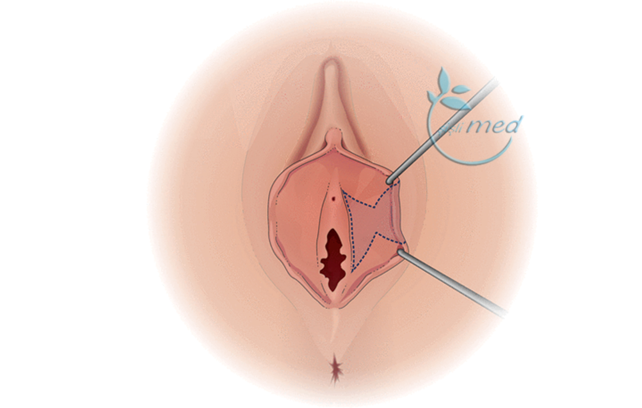 Vajina Küçük Dudakları Ameliyatı